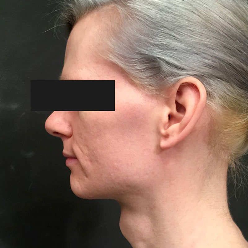 Facial Feminization 03