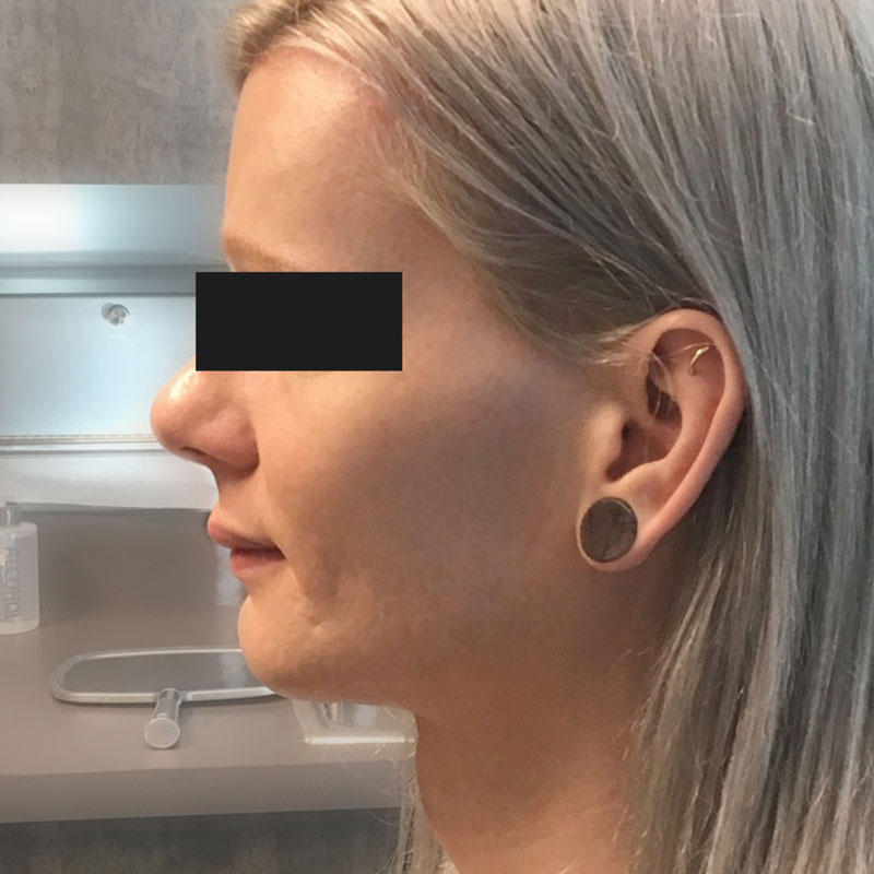 Facial Feminization 03