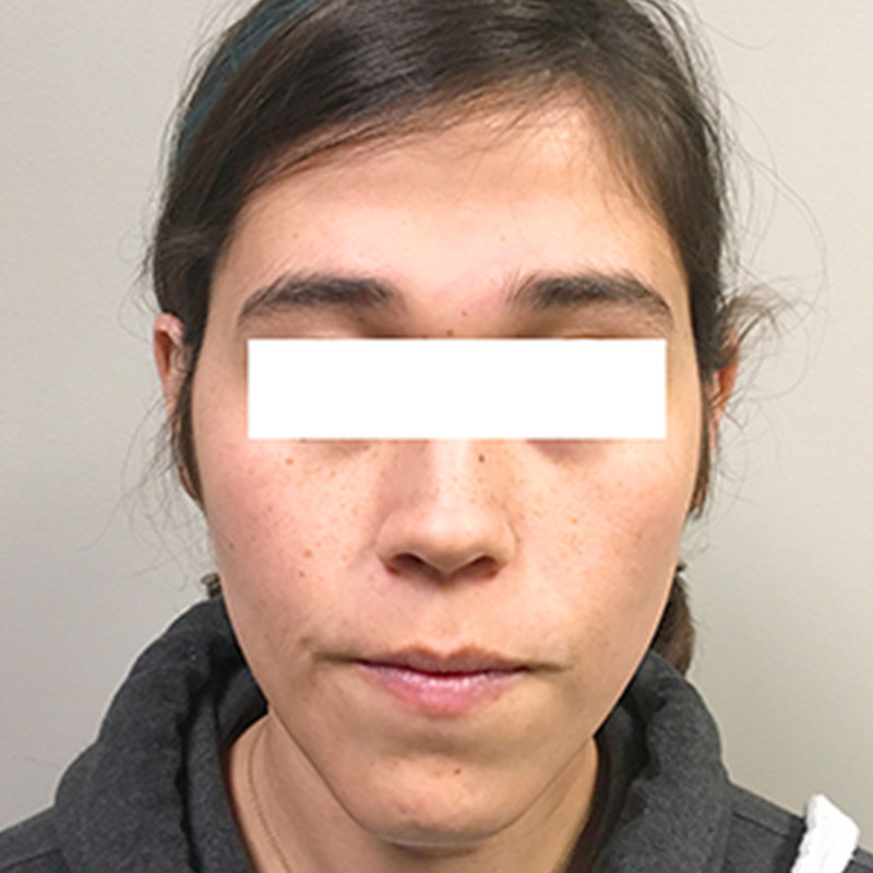 Facial Feminization 08