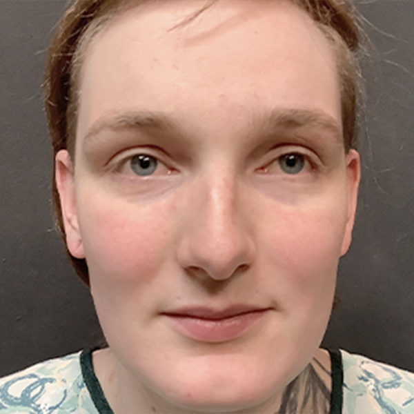 Facial Feminization 01