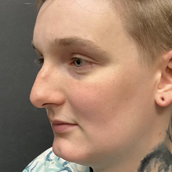 Facial Feminization 03