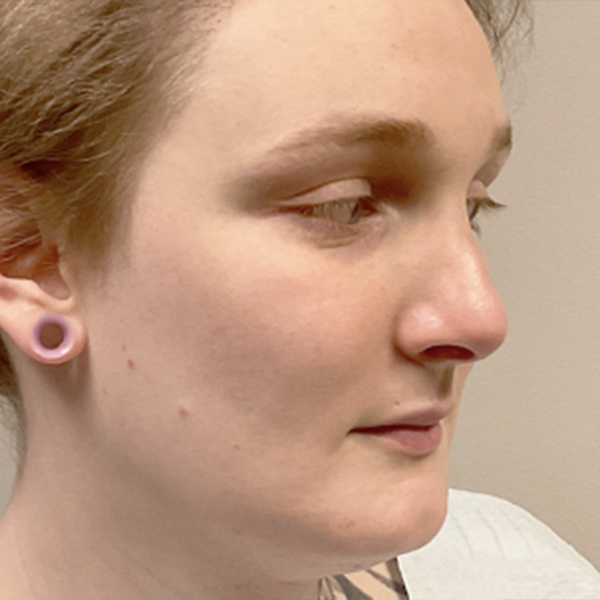 Facial Feminization 07