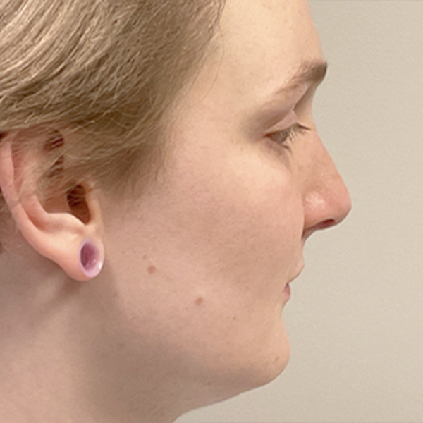 Facial Feminization 09