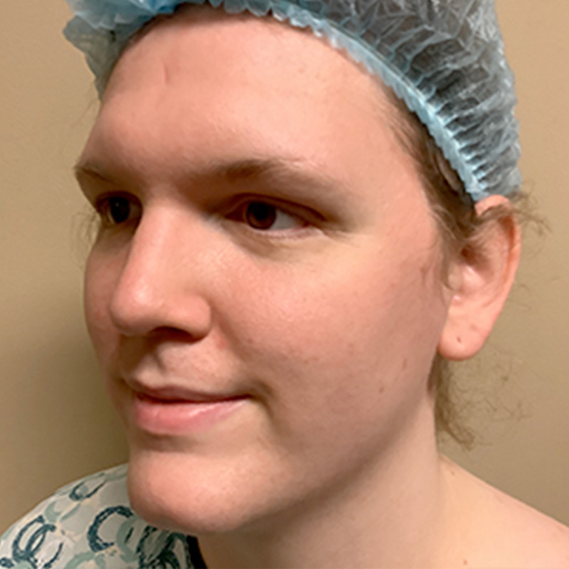 Facial Feminization 07