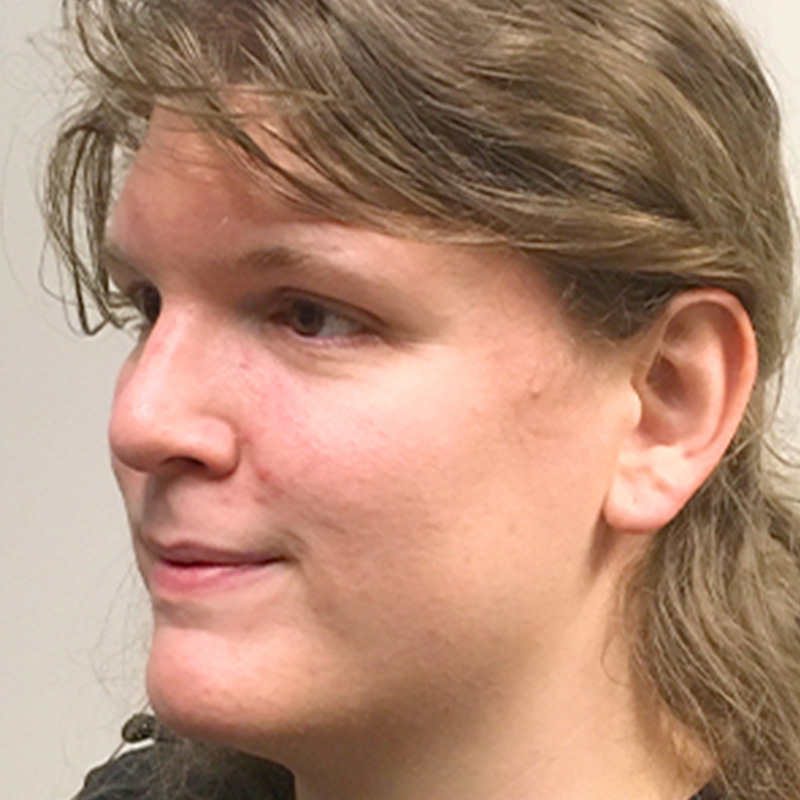 Facial Feminization 07