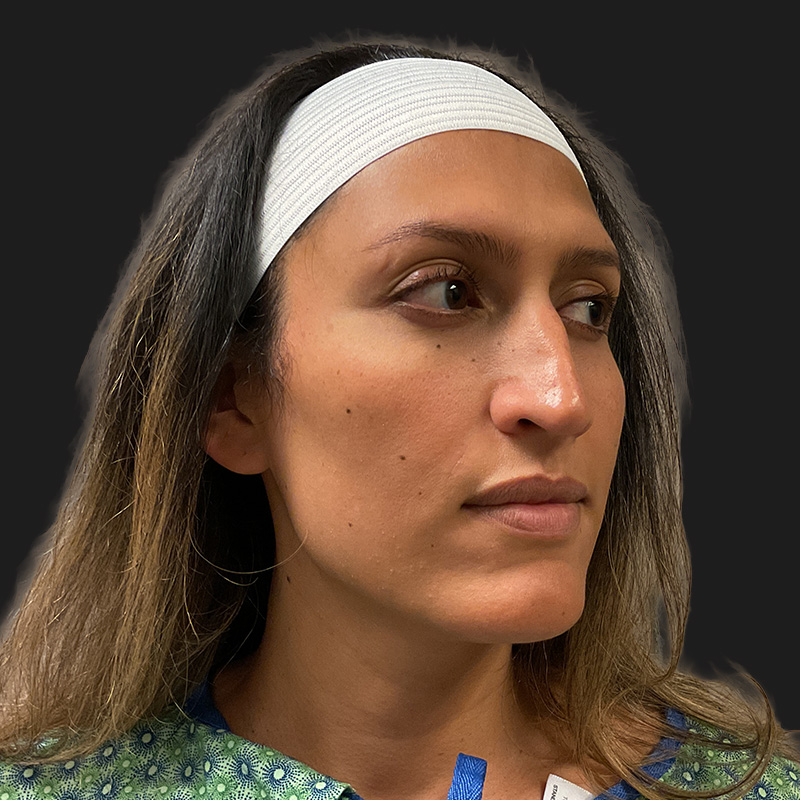 Facial Feminization 01