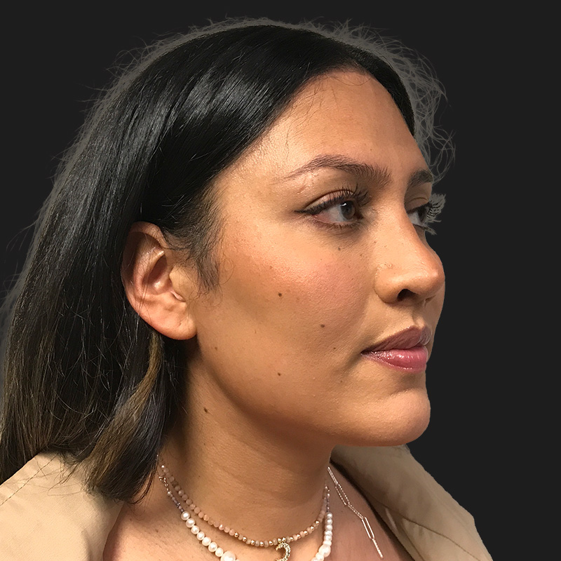 Facial Feminization 11