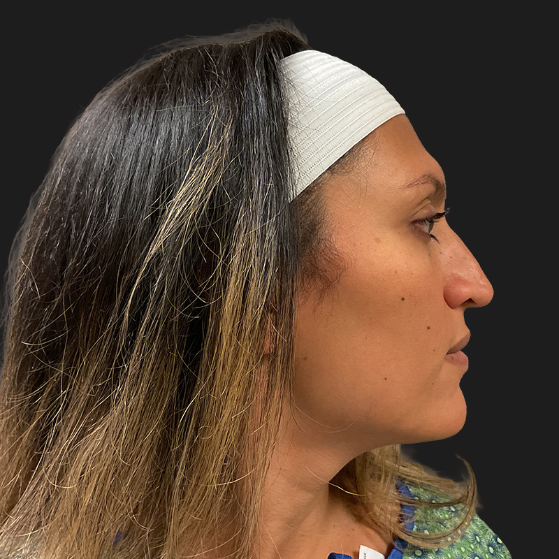 Facial Feminization 03