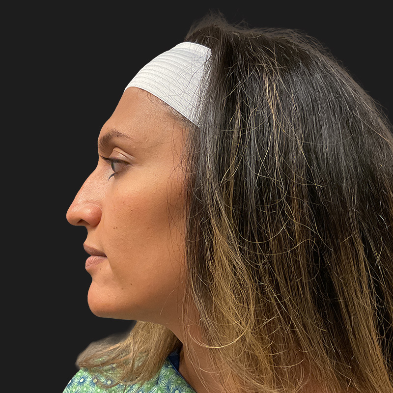 Facial Feminization 05