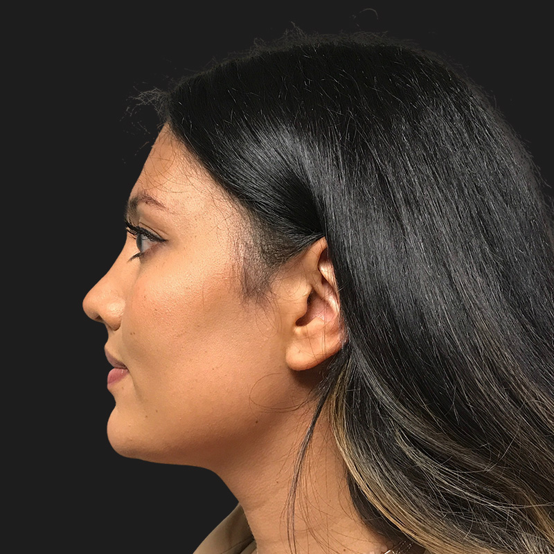 Facial Feminization 05