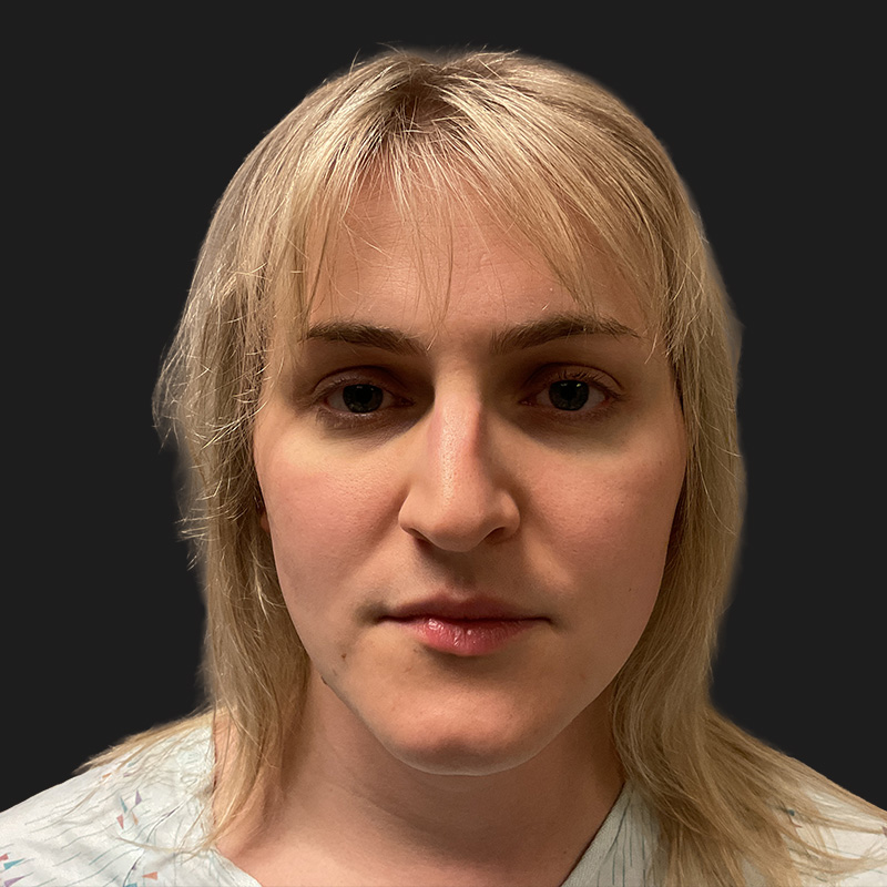 Facial Feminization 03