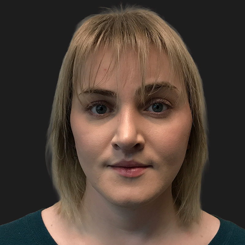 Facial Feminization 03