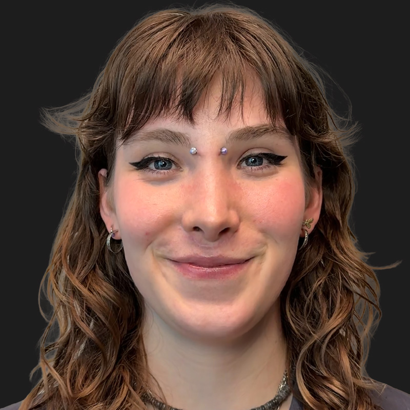 Facial Feminization 13