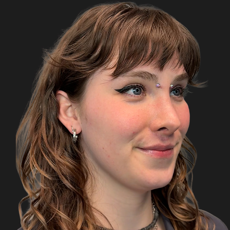 Facial Feminization 03