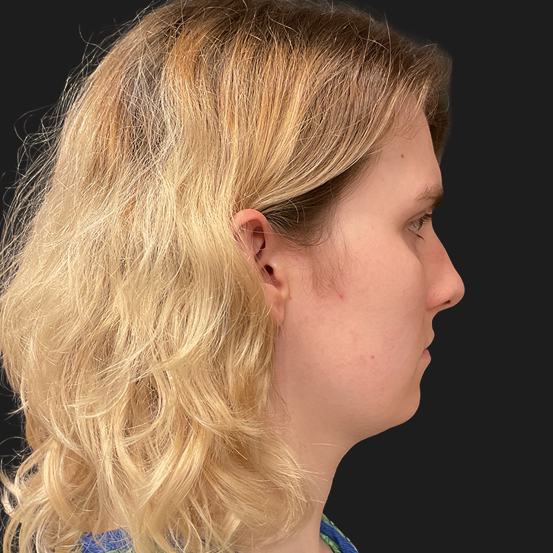 Facial Feminization 05