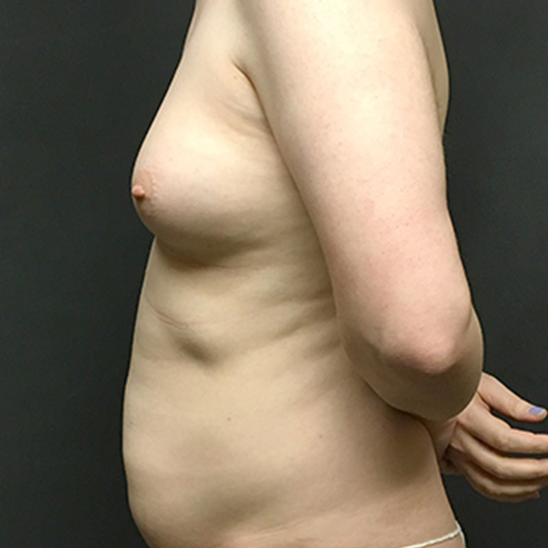 Fat Transfer To Breast 05