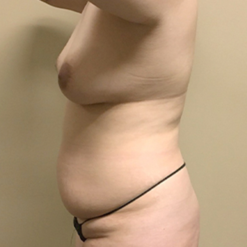 Fat Transfer To Breast 05