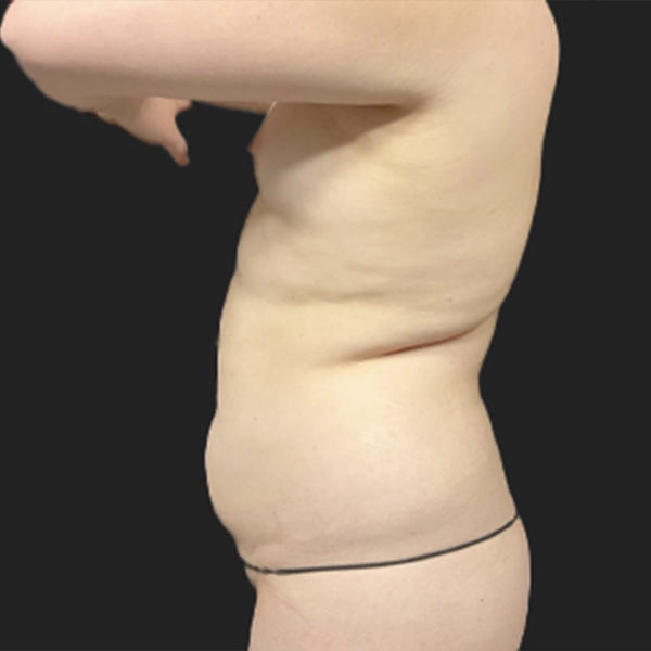 Fat Transfer To Breast 05