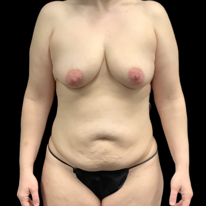 Fat Transfer To Breast 01