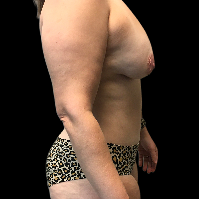 Fat Transfer To Breast 03