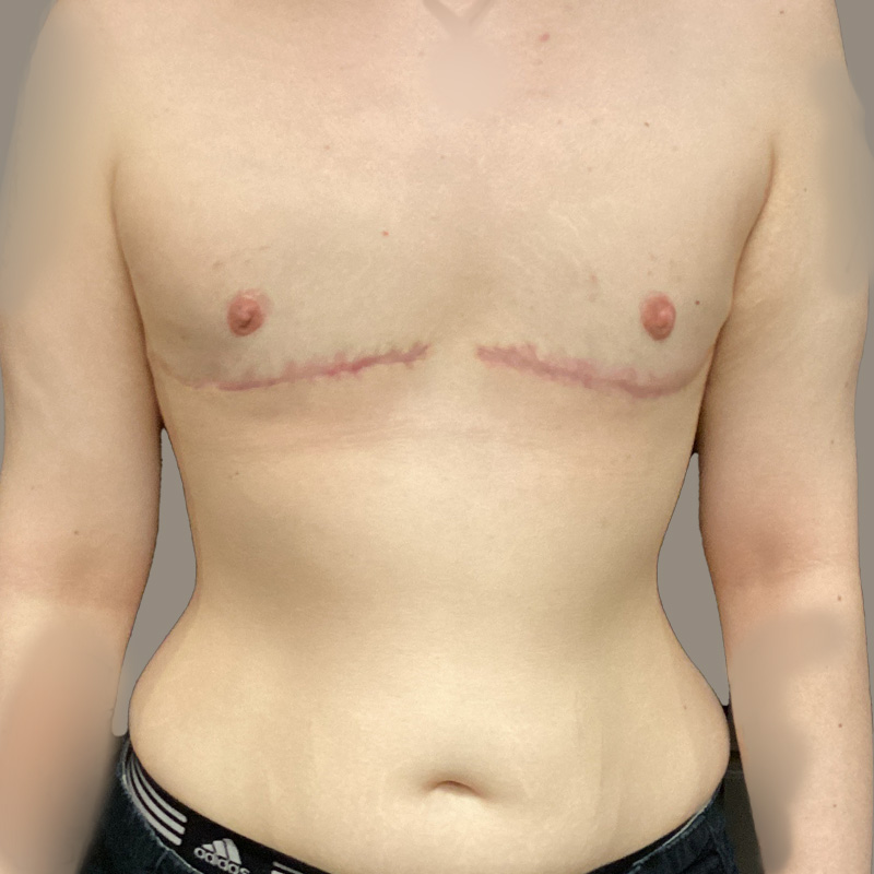 Female To Male Top Surgery 01