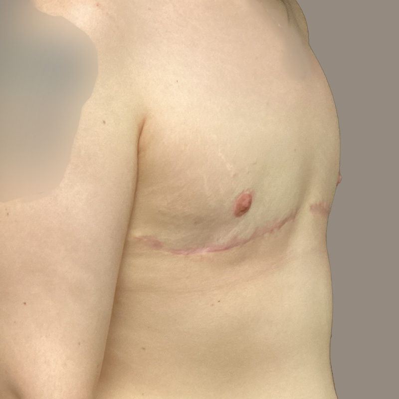 Female To Male Top Surgery 09