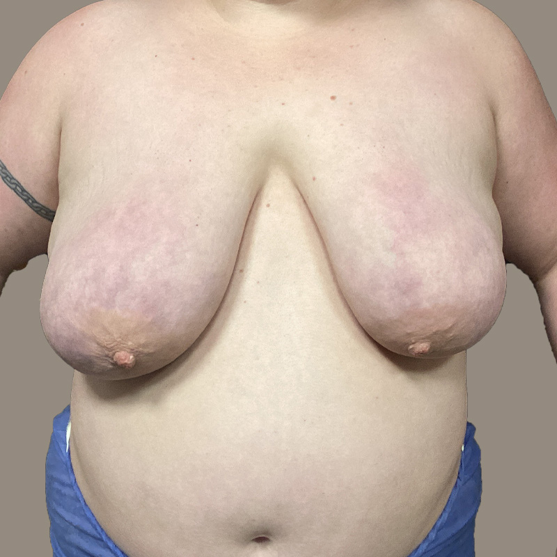 Female To Male Top Surgery 01