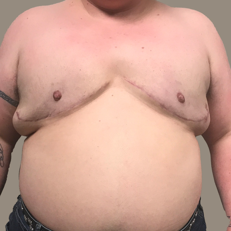 Female To Male Top Surgery 02