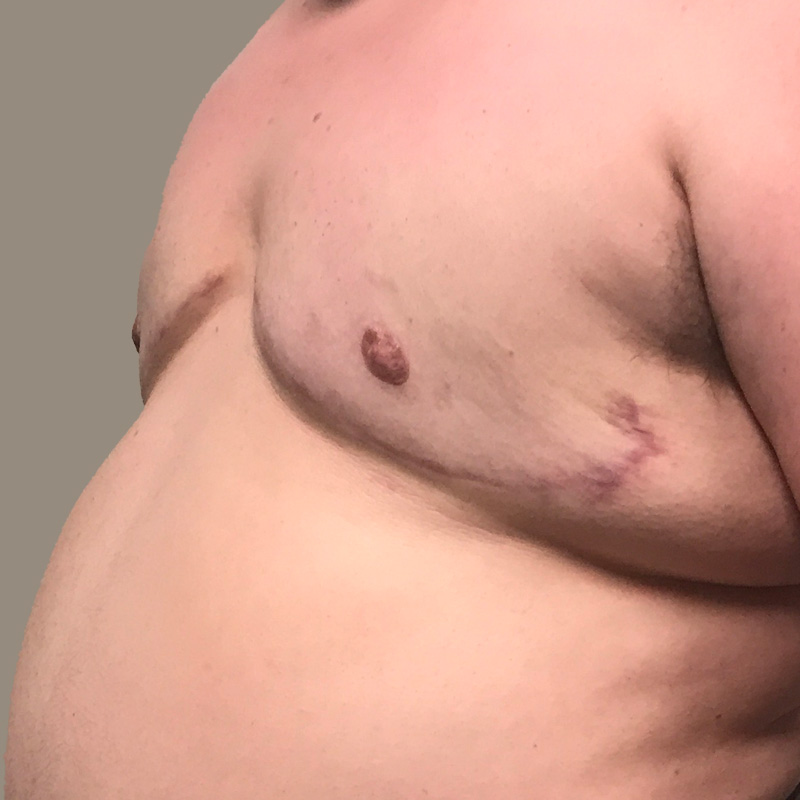 Female To Male Top Surgery 05