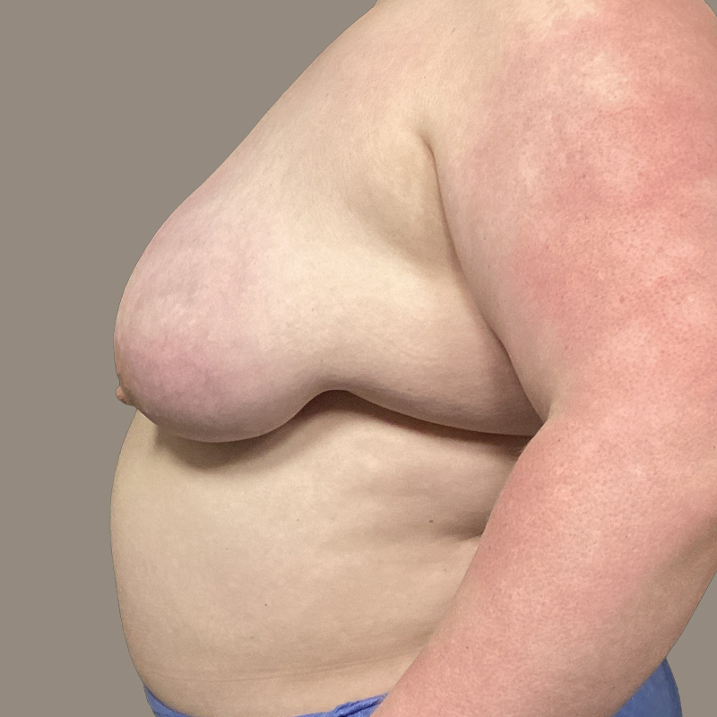 Female To Male Top Surgery 09