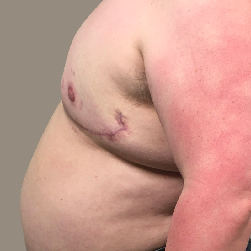 Female To Male Top Surgery 09