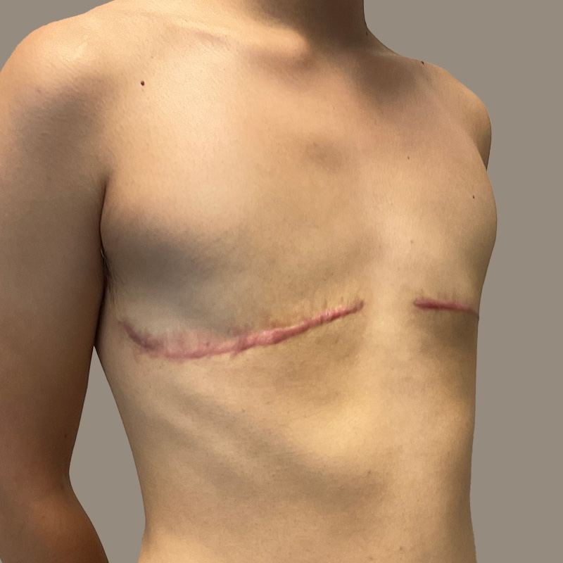 Female To Male Top Surgery 07