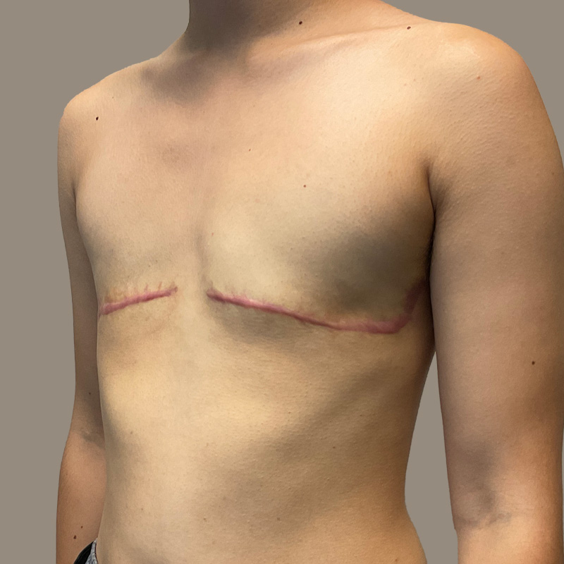 Female To Male Top Surgery 09