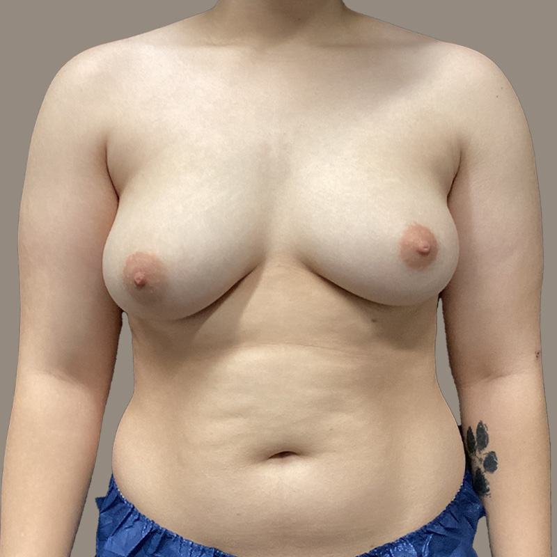 Female To Male Top Surgery 01