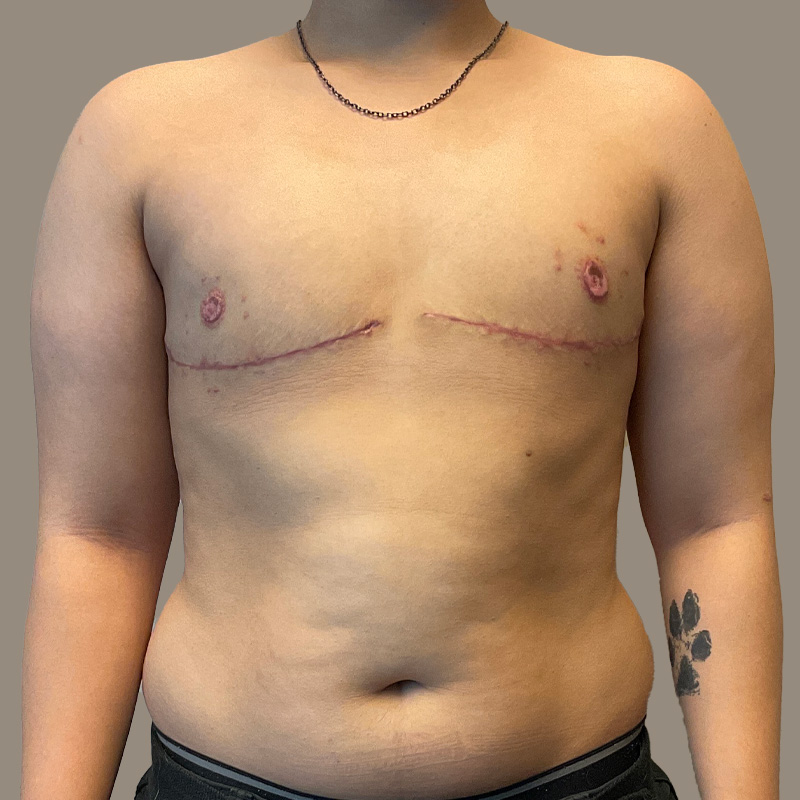 Female To Male Top Surgery 04