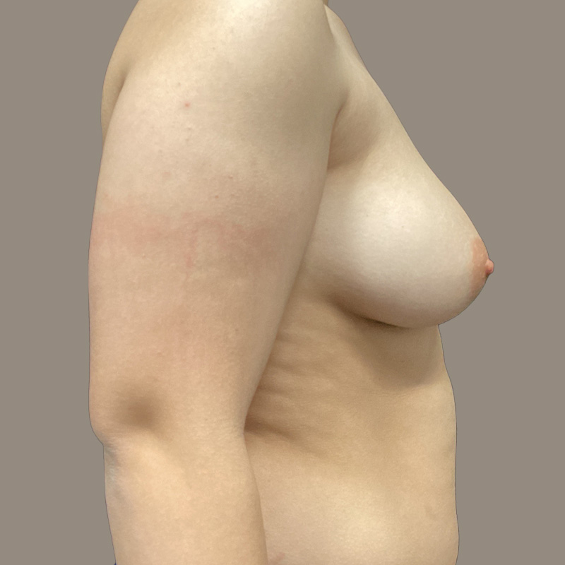 Female To Male Top Surgery 05