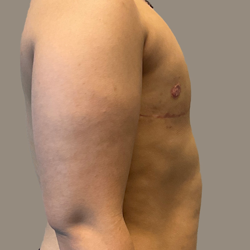 Female To Male Top Surgery 05