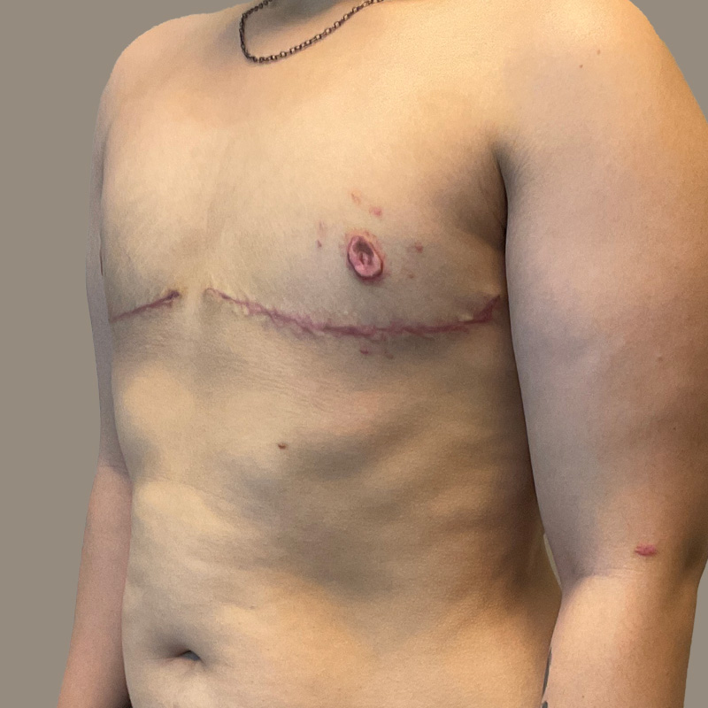 Female To Male Top Surgery 09