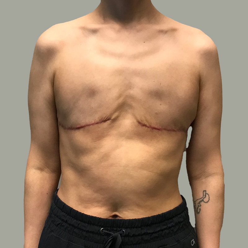 Female To Male Top Surgery 05