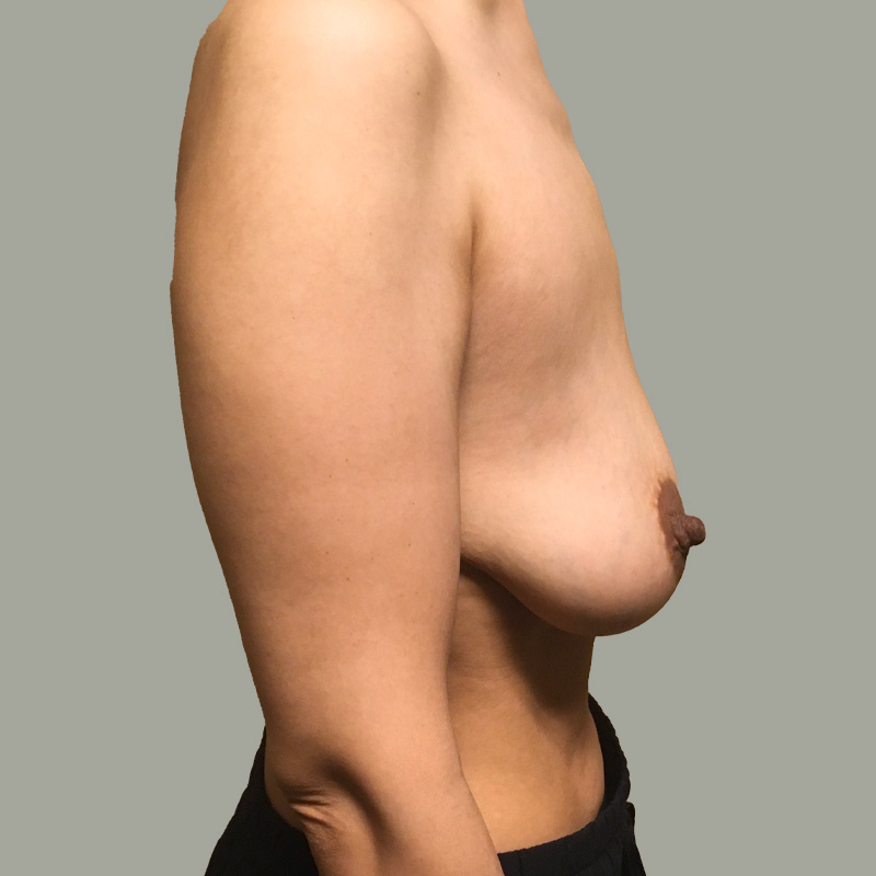 Female To Male Top Surgery 03