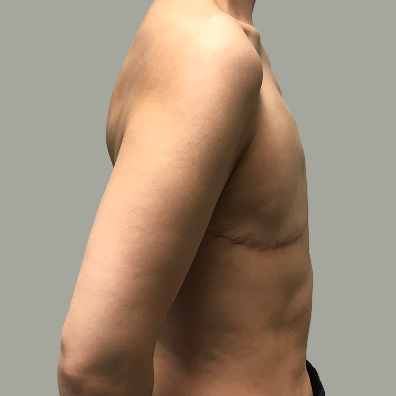 Female To Male Top Surgery 03