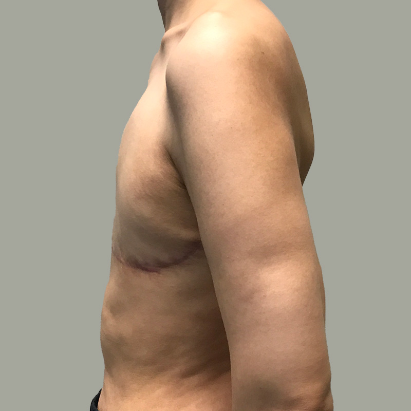 Female To Male Top Surgery 05