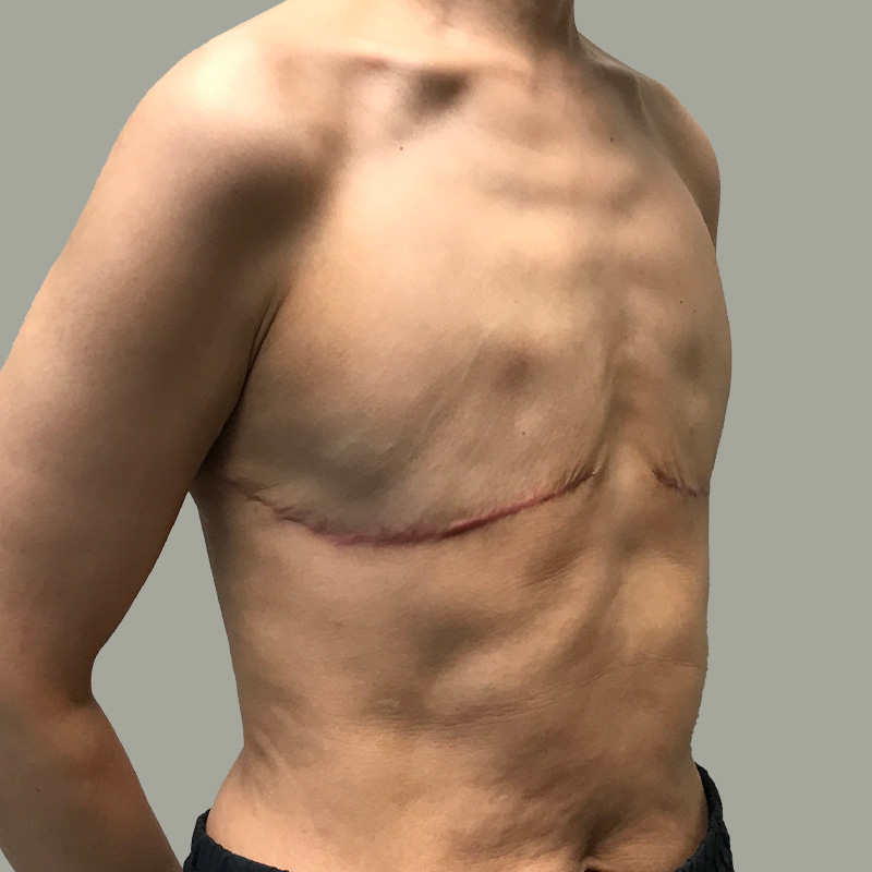 Female To Male Top Surgery 07