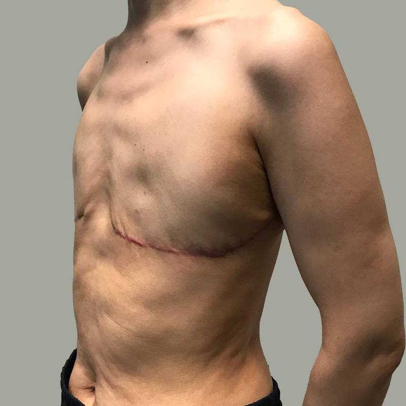 Female To Male Top Surgery 09