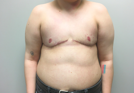 Female To Male Top Surgery 06