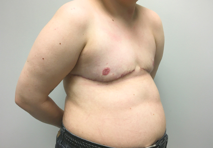 Female To Male Top Surgery 07