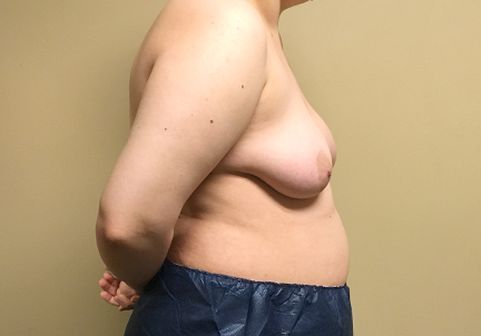 Female To Male Top Surgery 11