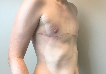 Female To Male Top Surgery 03