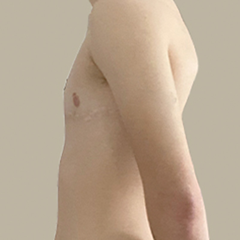 Female To Male Top Surgery 05