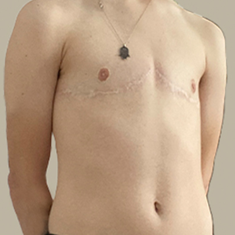 Female To Male Top Surgery 07